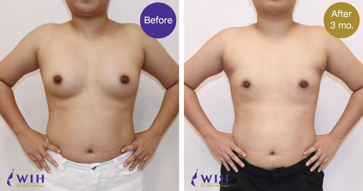 Female-to-Male Mastectomy