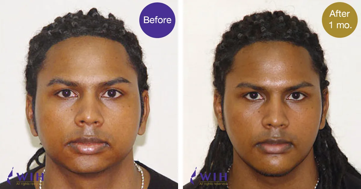 Case 4-Keshendra 121-06-Chin Implant เสริมคาง