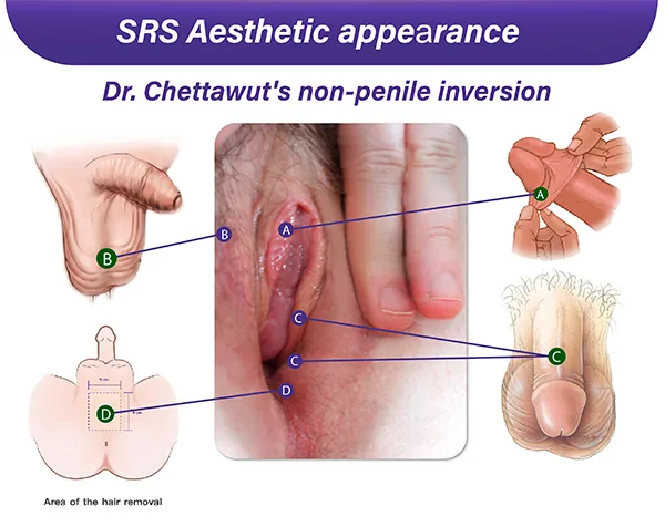 Dr. Chettawut's non-penile inversion technique