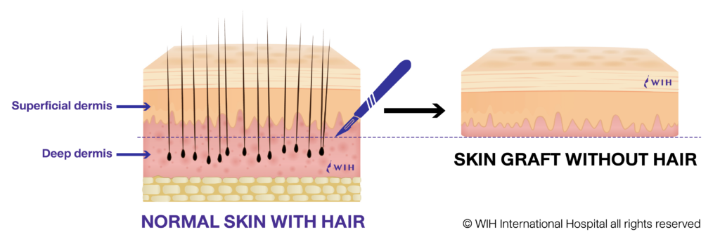 Skin graft vaginoplasty Gender Affirming Surgery