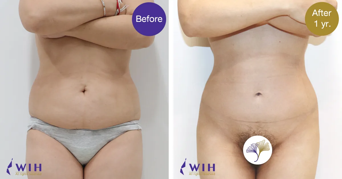 Tummy tuck Front view