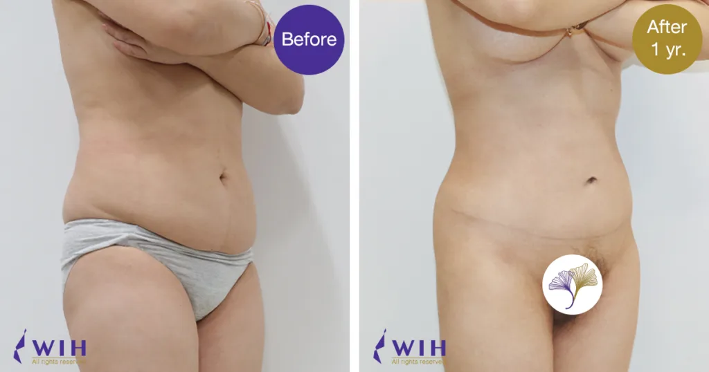 Tummy tuck semi 45 degree right view