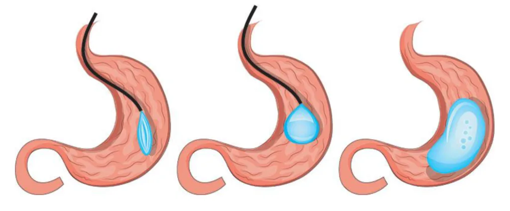 Gastric balloon