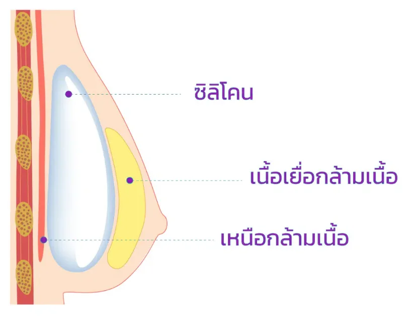 Breast augmentation 01