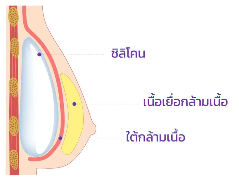 Breast augmentation 02