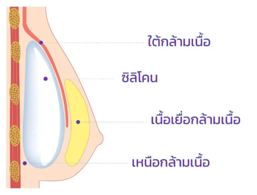 Breast augmentation 03