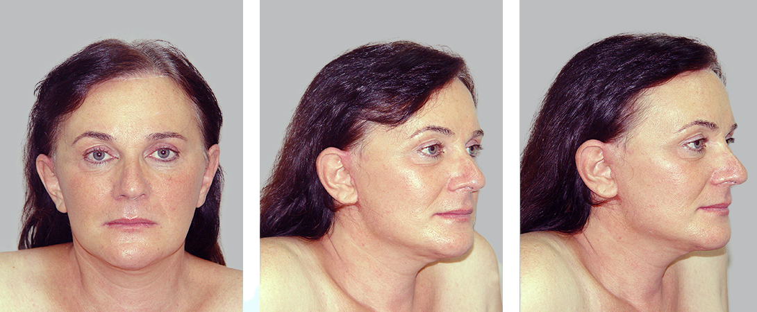 Photo Gallery 2 Ffs Gallery D Case 2 Facial Feminization Surgery Wih