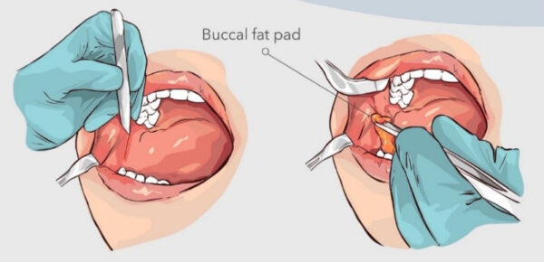 WIH Hospital What are the steps of a buccal fat removal procedure 03