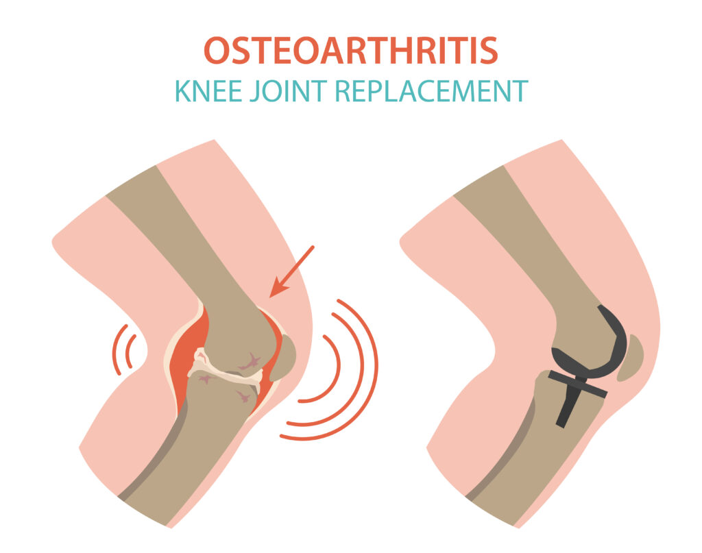 Indications for knee replacement surgery