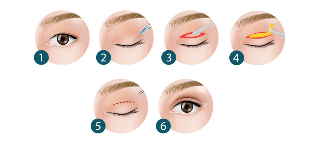 Eyelid Surgery