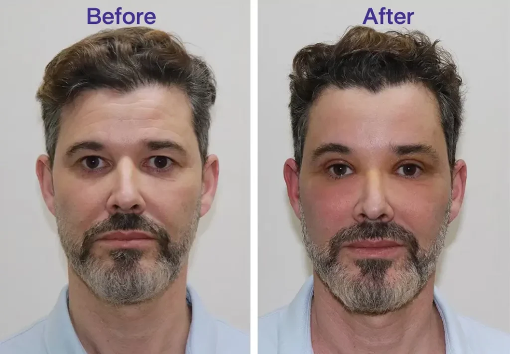 A before and after comparison of a man's face showing the results of a brow lift procedure. The before image shows drooping eyebrows and a tired appearance, while the after image shows lifted eyebrows and a more refreshed look.