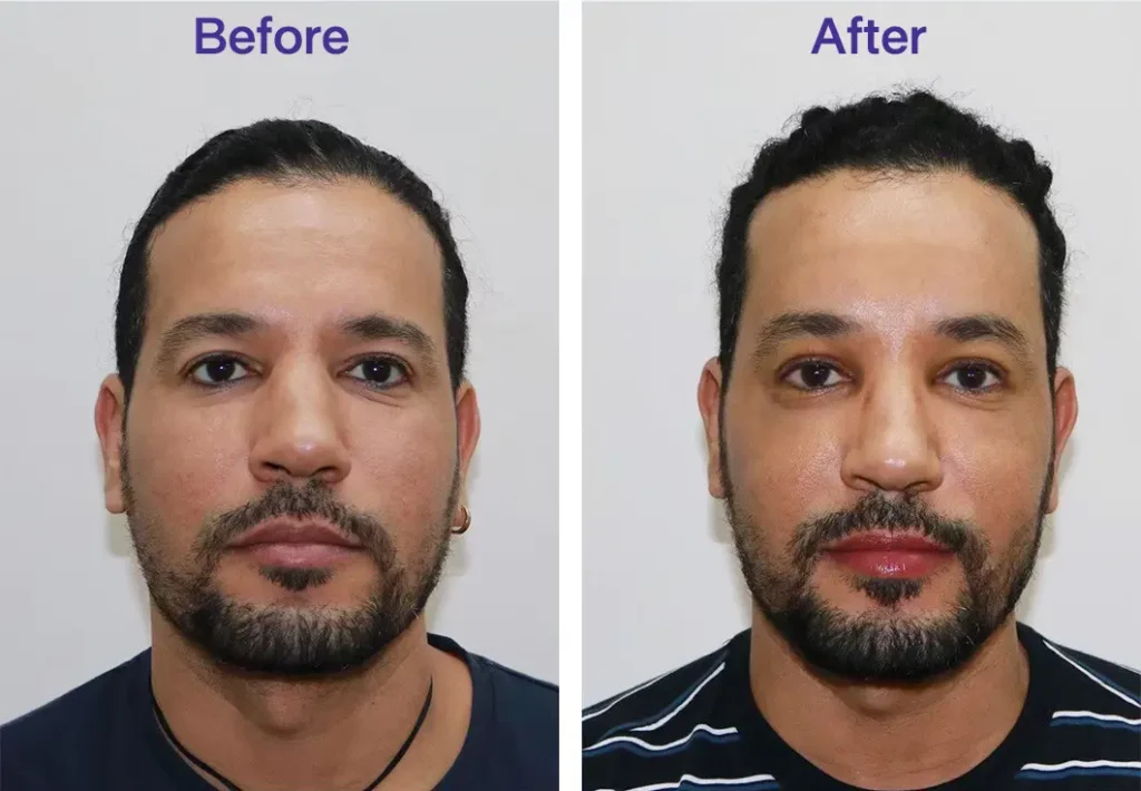 A before and after comparison of a man’s face showing the results of a brow lift procedure. The before image shows drooping eyebrows and a tired appearance, while the after image shows lifted eyebrows and a more refreshed look.