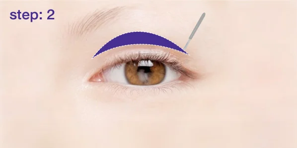 Eyelid with a marked incision line in purple and a surgical tool.