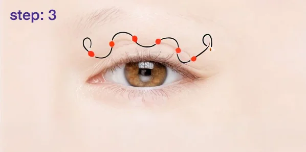 Eyelid with dotted suture points and a black suture line along the marked incision line.