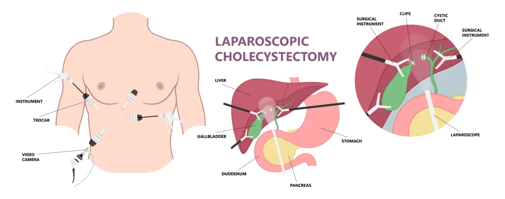 Laparoscopic Cholecystectomy (Gallbladder Removal Surgery)